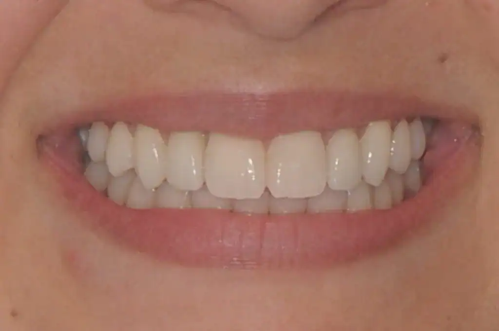 After photograph, smile case 2, published by Happy Smile Designers