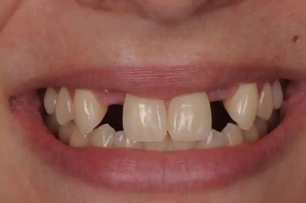 Before photograph, smile case 2, published by Happy Smile Designers